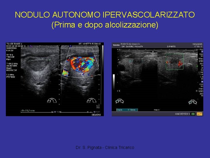 NODULO AUTONOMO IPERVASCOLARIZZATO (Prima e dopo alcolizzazione) Dr. S. Pignata - Clinica Tricarico 