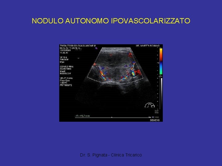NODULO AUTONOMO IPOVASCOLARIZZATO Dr. S. Pignata - Clinica Tricarico 