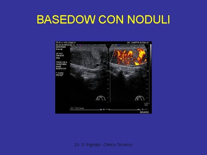 BASEDOW CON NODULI Dr. S. Pignata - Clinica Tricarico 