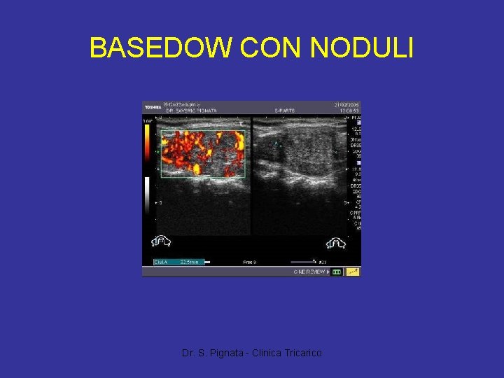 BASEDOW CON NODULI Dr. S. Pignata - Clinica Tricarico 