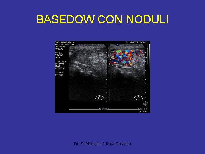 BASEDOW CON NODULI Dr. S. Pignata - Clinica Tricarico 