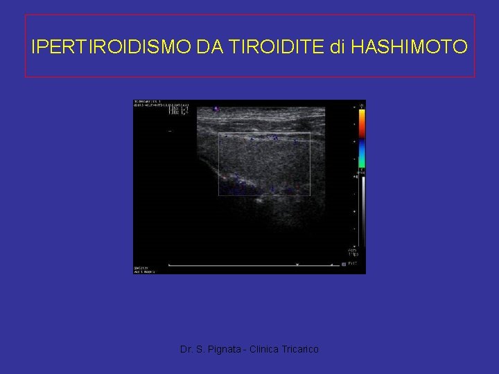 IPERTIROIDISMO DA TIROIDITE di HASHIMOTO Dr. S. Pignata - Clinica Tricarico 