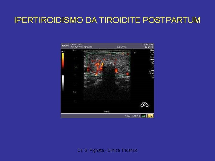 IPERTIROIDISMO DA TIROIDITE POSTPARTUM Dr. S. Pignata - Clinica Tricarico 