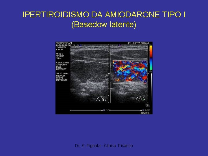 IPERTIROIDISMO DA AMIODARONE TIPO I (Basedow latente) Dr. S. Pignata - Clinica Tricarico 