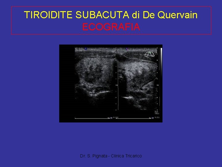 TIROIDITE SUBACUTA di De Quervain ECOGRAFIA Dr. S. Pignata - Clinica Tricarico 