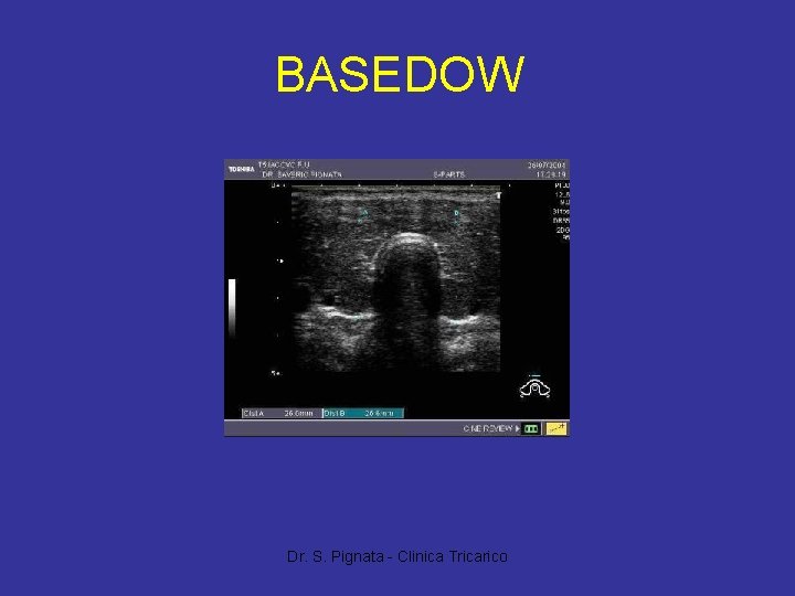 BASEDOW Dr. S. Pignata - Clinica Tricarico 