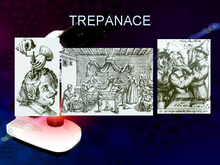 TREPANACE 