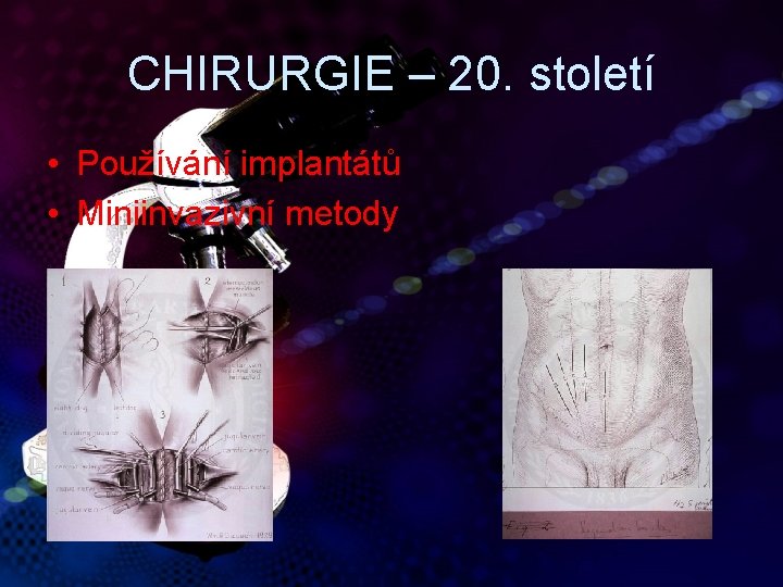 CHIRURGIE – 20. století • Používání implantátů • Miniinvazivní metody 