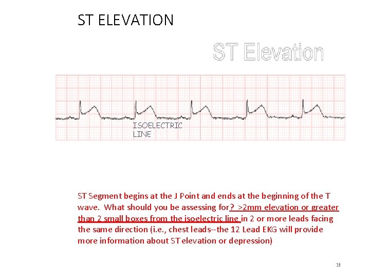 ST ELEVATION ISOELECTRIC LINE ST Segment begins at the J Point and ends at