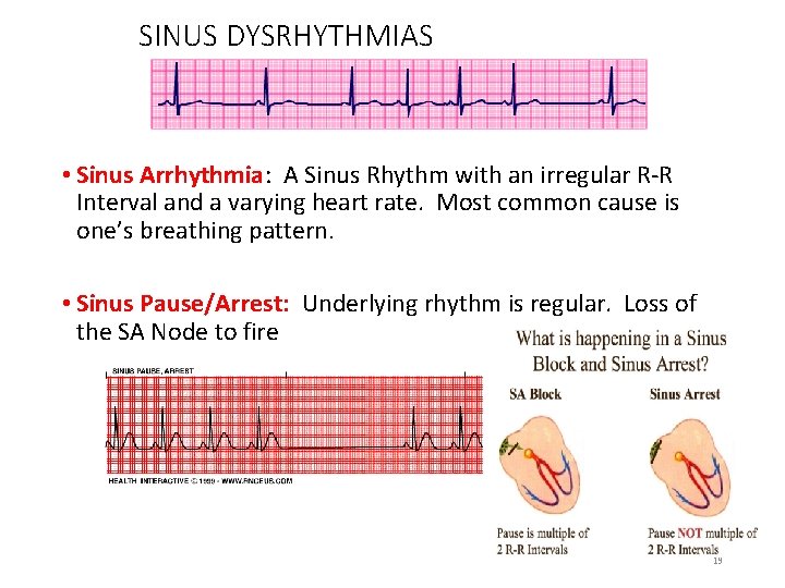 SINUS DYSRHYTHMIAS • Sinus Arrhythmia: A Sinus Rhythm with an irregular R-R Interval and