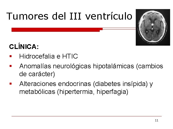 Tumores del III ventrículo CLÍNICA: § Hidrocefalia e HTIC § Anomalías neurológicas hipotalámicas (cambios