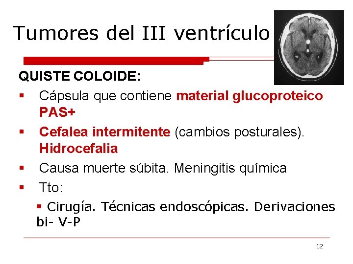 Tumores del III ventrículo QUISTE COLOIDE: § Cápsula que contiene material glucoproteico PAS+ §