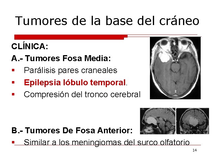 Tumores de la base del cráneo CLÍNICA: A. - Tumores Fosa Media: § Parálisis