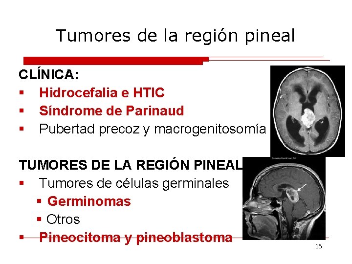 Tumores de la región pineal CLÍNICA: § Hidrocefalia e HTIC § Síndrome de Parinaud