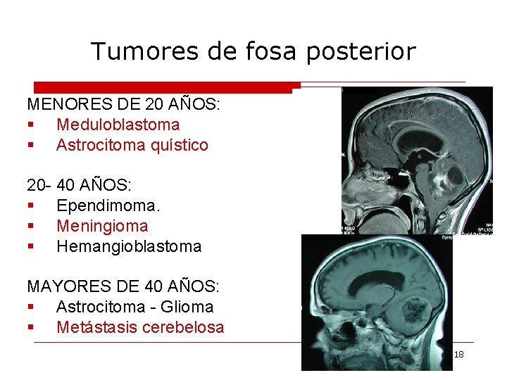 Tumores de fosa posterior MENORES DE 20 AÑOS: § Meduloblastoma § Astrocitoma quístico 20