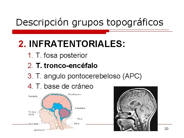 Descripción grupos topográficos 2. INFRATENTORIALES: 1. T. fosa posterior 2. T. tronco-encéfalo 3. T.