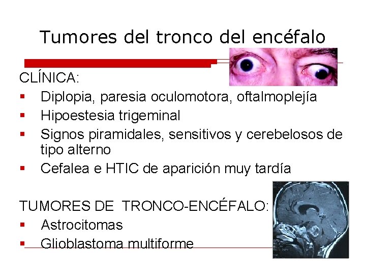 Tumores del tronco del encéfalo CLÍNICA: § Diplopia, paresia oculomotora, oftalmoplejía § Hipoestesia trigeminal