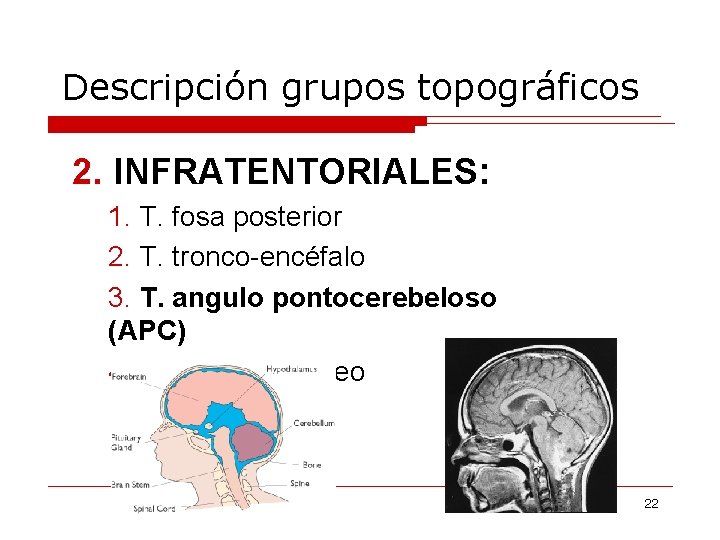 Descripción grupos topográficos 2. INFRATENTORIALES: 1. T. fosa posterior 2. T. tronco-encéfalo 3. T.