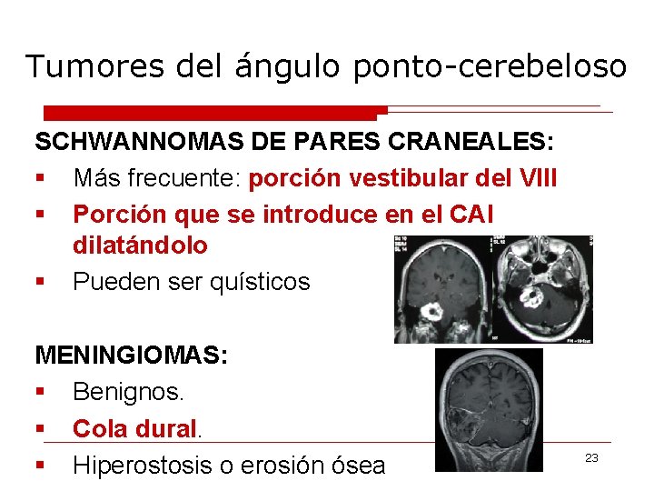 Tumores del ángulo ponto-cerebeloso SCHWANNOMAS DE PARES CRANEALES: § Más frecuente: porción vestibular del