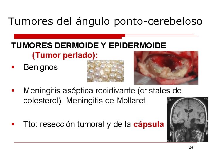 Tumores del ángulo ponto-cerebeloso TUMORES DERMOIDE Y EPIDERMOIDE (Tumor perlado): § Benignos § Meningitis