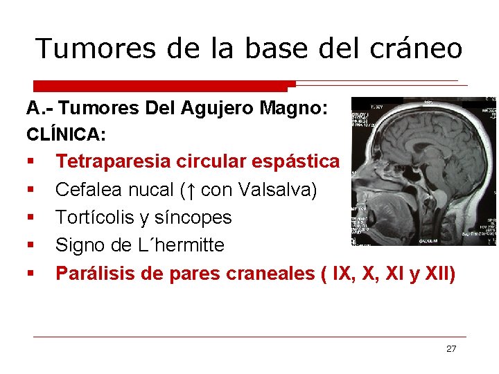 Tumores de la base del cráneo A. - Tumores Del Agujero Magno: CLÍNICA: §