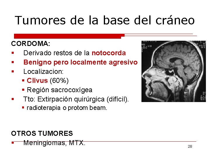 Tumores de la base del cráneo CORDOMA: § Derivado restos de la notocorda §