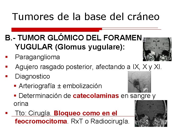 Tumores de la base del cráneo B. - TUMOR GLÓMICO DEL FORAMEN YUGULAR (Glomus