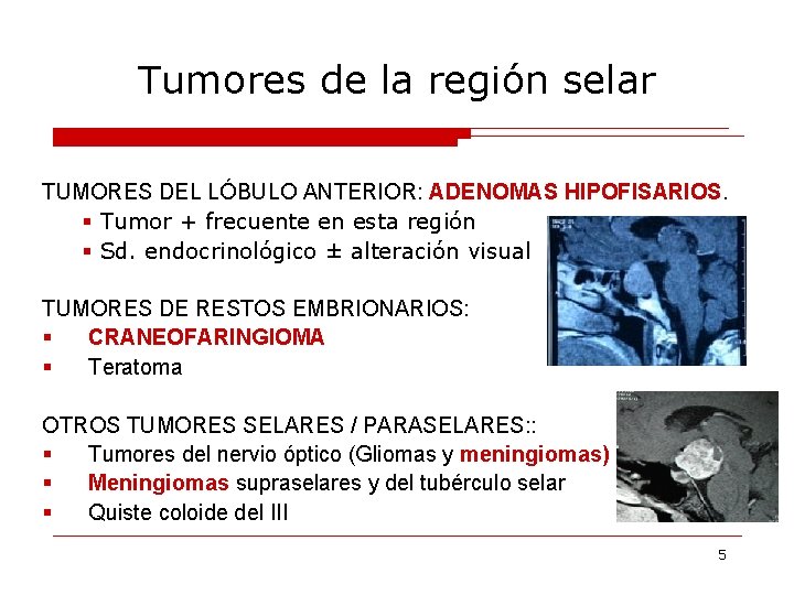 Tumores de la región selar TUMORES DEL LÓBULO ANTERIOR: ADENOMAS HIPOFISARIOS. § Tumor +