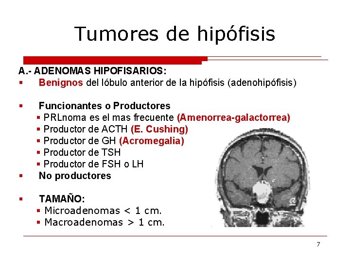 Tumores de hipófisis A. - ADENOMAS HIPOFISARIOS: § Benignos del lóbulo anterior de la