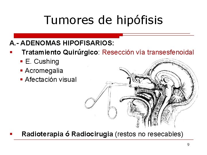 Tumores de hipófisis A. - ADENOMAS HIPOFISARIOS: § Tratamiento Quirúrgico: Resección vía transesfenoidal §