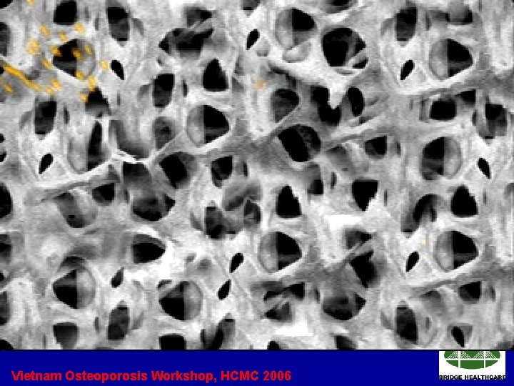 Vietnam Osteoporosis Workshop, HCMC 2006 