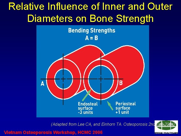 Relative Influence of Inner and Outer Diameters on Bone Strength (Adapted from Lee CA,