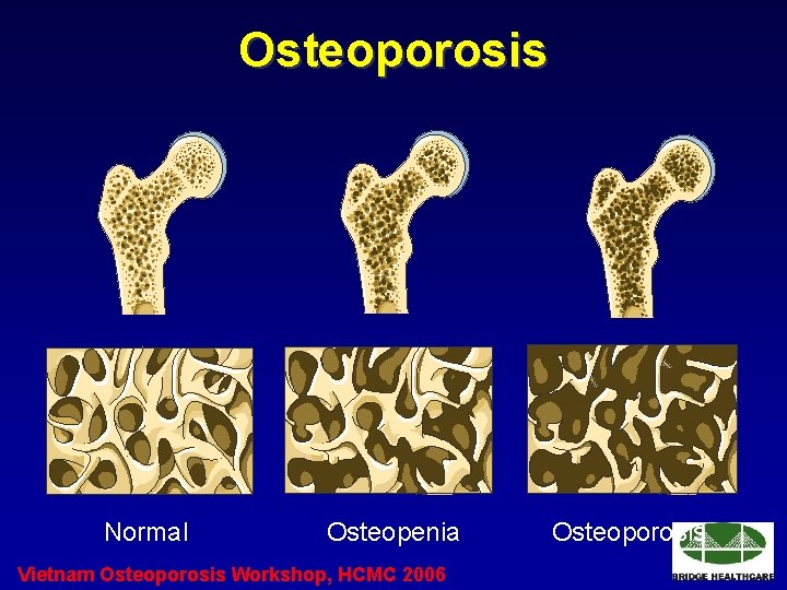 Osteoporosis Normal Osteopenia Vietnam Osteoporosis Workshop, HCMC 2006 Osteoporosis 