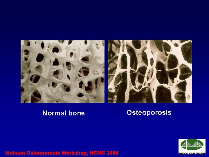 Normal bone Vietnam Osteoporosis Workshop, HCMC 2006 Osteoporosis 