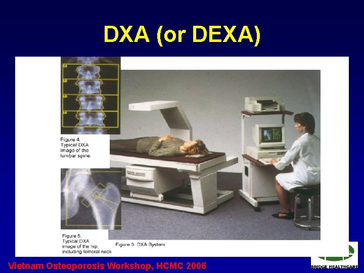 DXA (or DEXA) Vietnam Osteoporosis Workshop, HCMC 2006 DXA (or DEXA) Vietnam Osteoporosis Workshop, HCMC 2006