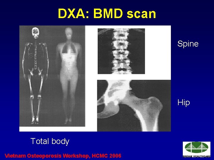 DXA: BMD scan Spine Hip Total body Vietnam Osteoporosis Workshop, HCMC 2006 DXA: BMD scan Spine Hip Total body Vietnam Osteoporosis Workshop, HCMC 2006