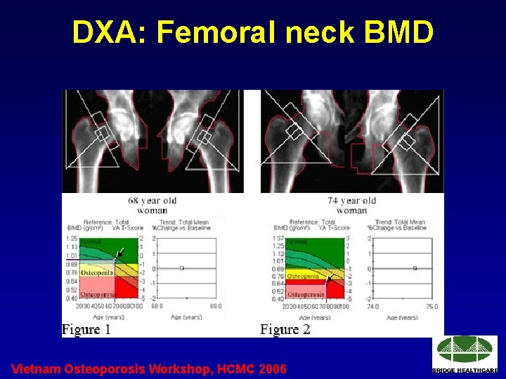 DXA: Femoral neck BMD Vietnam Osteoporosis Workshop, HCMC 2006 