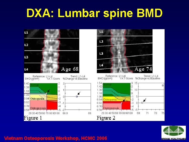 DXA: Lumbar spine BMD Vietnam Osteoporosis Workshop, HCMC 2006 