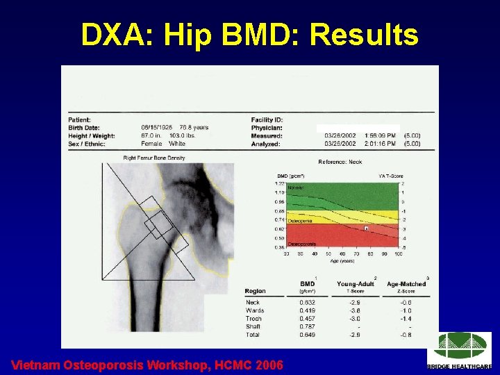 DXA: Hip BMD: Results Vietnam Osteoporosis Workshop, HCMC 2006 
