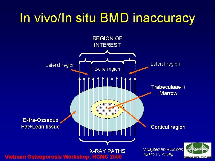 In vivo/In situ BMD inaccuracy REGION OF INTEREST Lateral region Bone region Lateral region