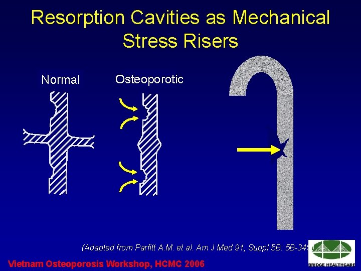 Resorption Cavities as Mechanical Stress Risers Normal Osteoporotic (Adapted from Parfitt A. M. et