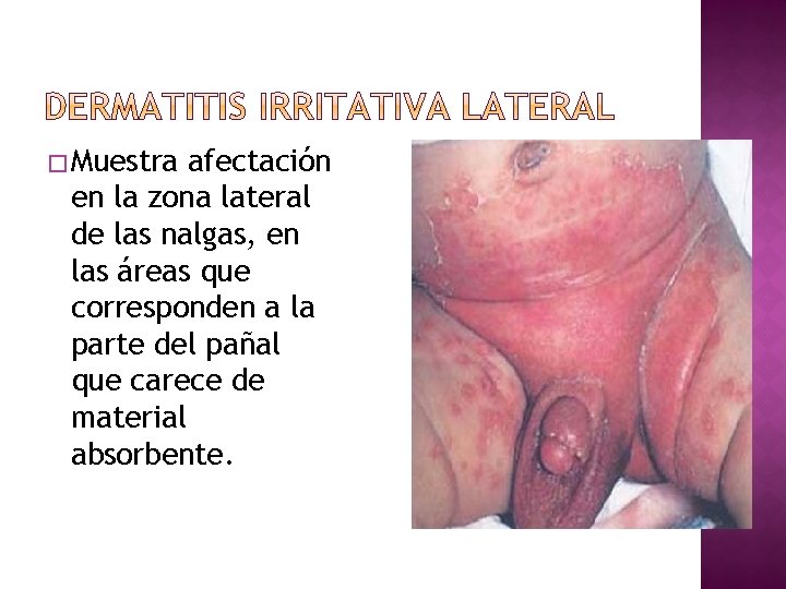 � Muestra afectación en la zona lateral de las nalgas, en las áreas que