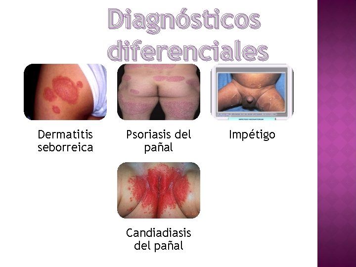 Diagnósticos diferenciales Dermatitis seborreica Psoriasis del pañal Candiadiasis del pañal Impétigo 