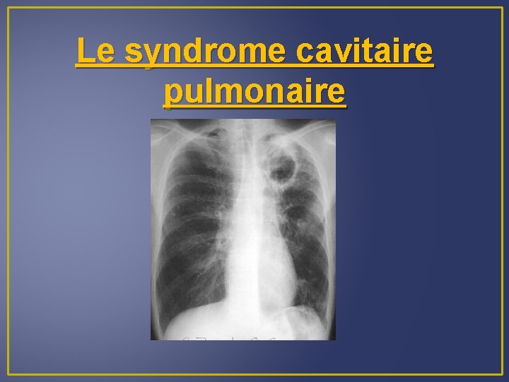 Le syndrome cavitaire pulmonaire 