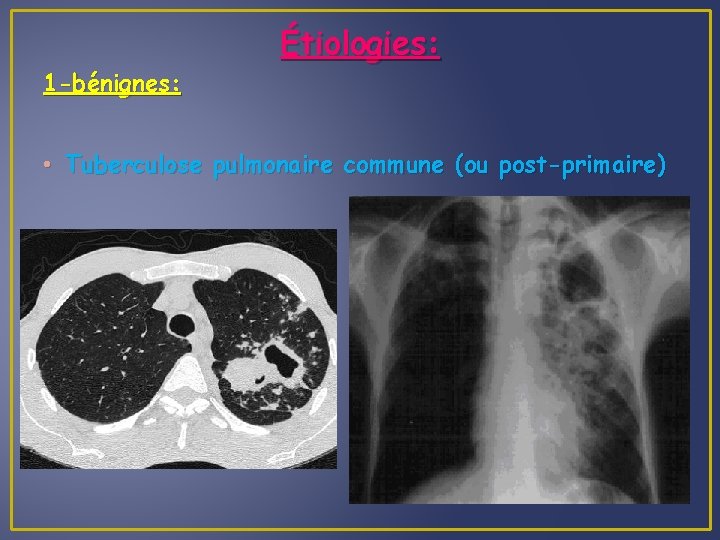 1 -bénignes: Étiologies: • Tuberculose pulmonaire commune (ou post-primaire) 