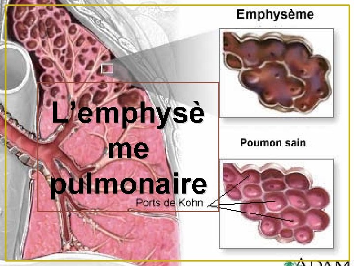 L’emphysè me pulmonaire 