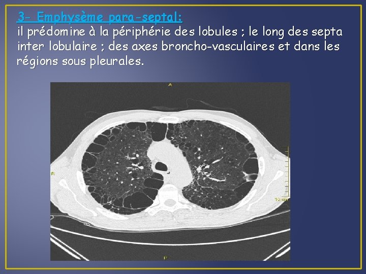 3 - Emphysème para-septal: il prédomine à la périphérie des lobules ; le long