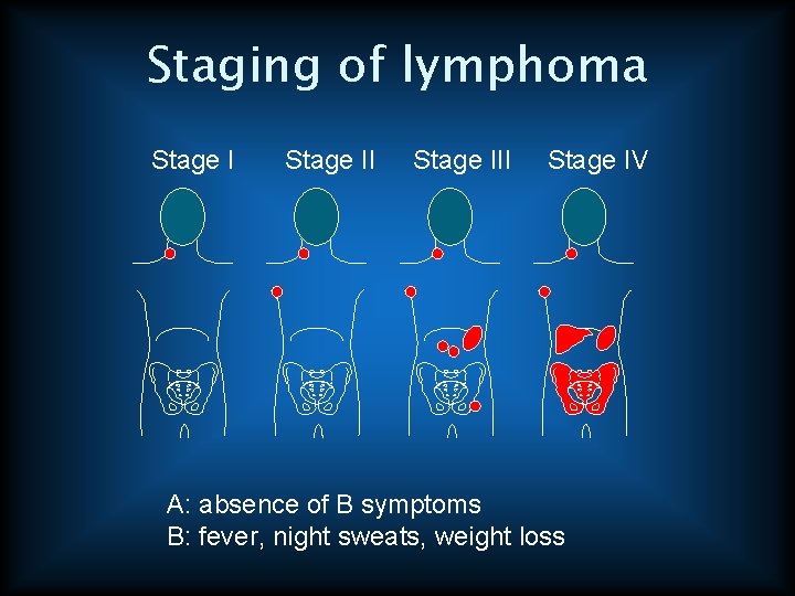 Staging of lymphoma Stage III Stage IV A: absence of B symptoms B: fever,