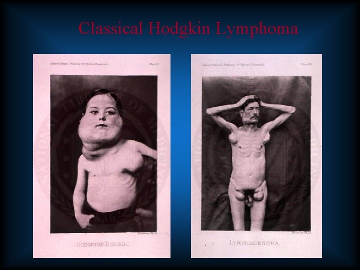 Classical Hodgkin Lymphoma 