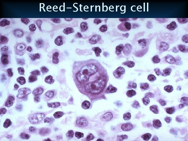 Reed-Sternberg cell 